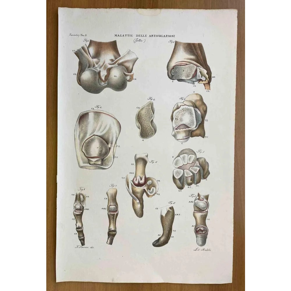 Ottavio Muzzi, Joint Diseases, Lithograph, 1843 | Chairish