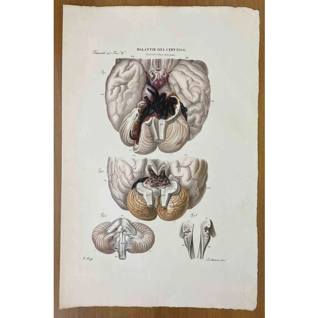 Ottavio Muzzi, Brain Diseases, Lithograph, 1843 For Sale