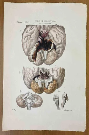 Ottavio Muzzi, Brain Diseases, Lithograph, 1843