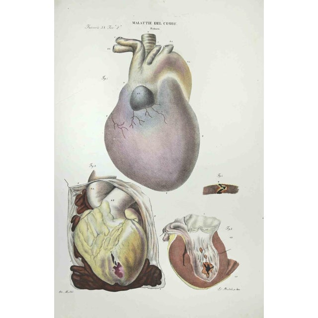 Heart Diseases is a lithograph hand colored by Ottavio Muzzi for the edition of Antoine Chazal,Human Anatomy, Printers...