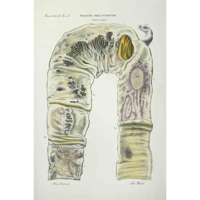 Bowel Diseases is a lithograph hand colored by Ottavio Muzzi for the edition of Antoine Chazal, Human Anatomy, Printers...