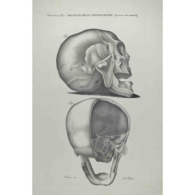 Joint Diseases is a lithograph hand colored by Ottavio Muzzi for the edition of Antoine Chazal, Human Anatomy, Printers...