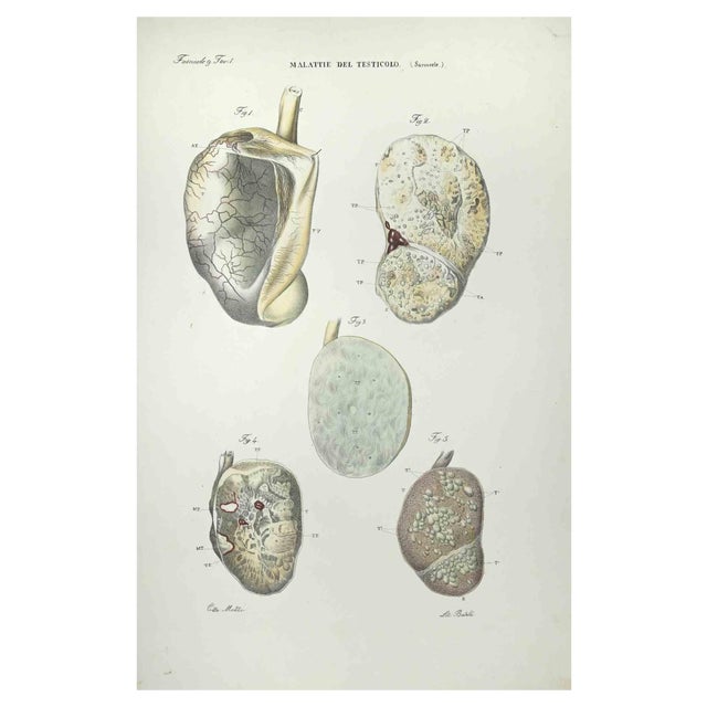 Ottavio Muzzi, Testicular Diseases, Lithograph, 1843 For Sale