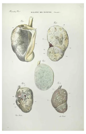 Ottavio Muzzi, Testicular Diseases, Lithograph, 1843