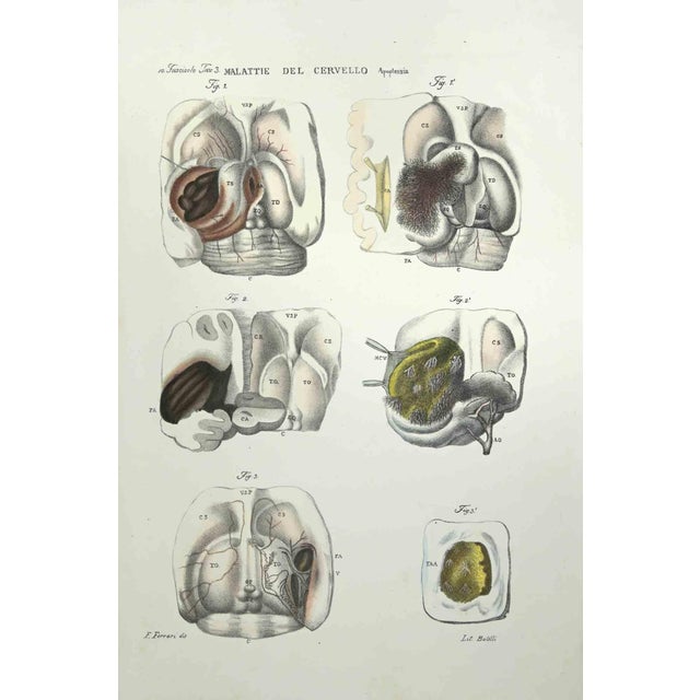 Brain Diseases is a lithograph hand colored by Ottavio Muzzi for the edition of Antoine Chazal, Human Anatomy, Printers...