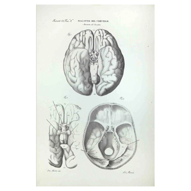 Ottavio Muzzi, Brain Diseases, Lithograph, 1843 For Sale