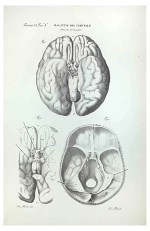 Ottavio Muzzi, Brain Diseases, Lithograph, 1843
