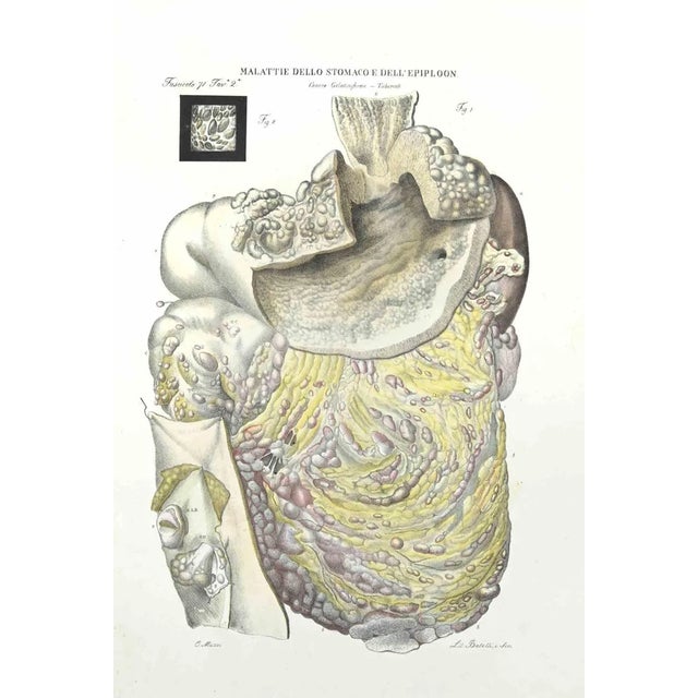 Deseaes of the Stomach of Epiploon is a lithograph hand colored by Ottavio Muzzi for the edition of Antoine Chazal,Human...