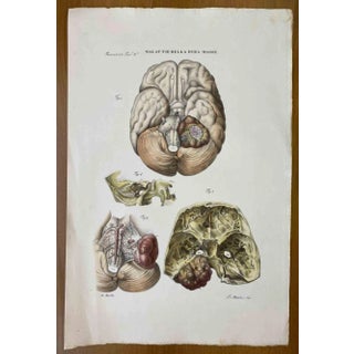 Ottavio Muzzi, Diseases of the Dura Mater, Lithograph, 1843 For Sale