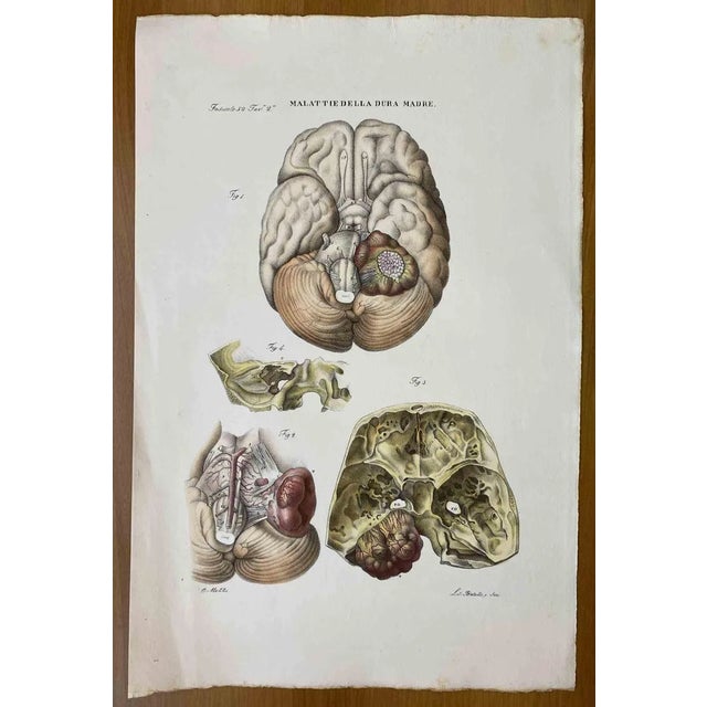 Ottavio Muzzi, Diseases of the Dura Mater, Lithograph, 1843 For Sale