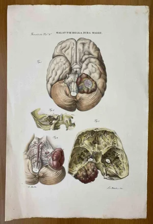 Ottavio Muzzi, Diseases of the Dura Mater, Lithograph, 1843