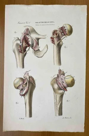 Ottavio Muzzi, Bone Diseases, Lithograph, 1843