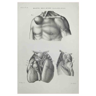 Ottavio Muzzi, Diseases of the Arteries, Lithograph, 1843 For Sale