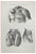 Ottavio Muzzi, Diseases of the Arteries, Lithograph, 1843 For Sale