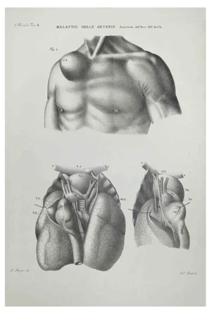 Ottavio Muzzi, Diseases of the Arteries, Lithograph, 1843