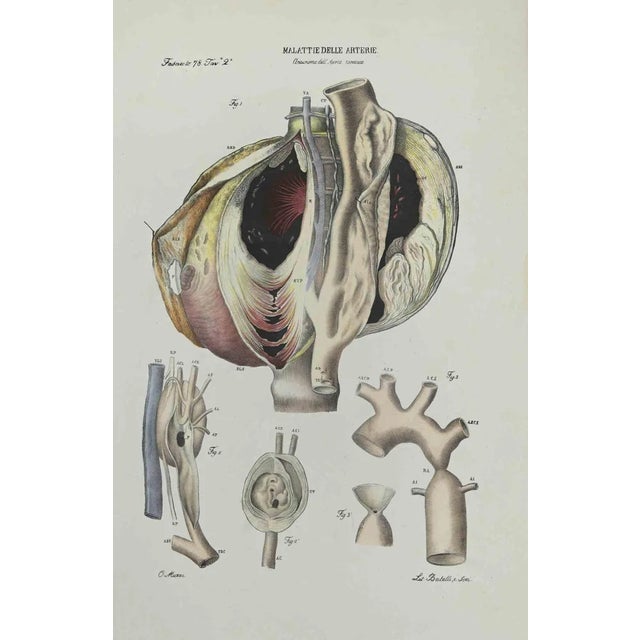 Ottavio Muzzi, Liver Disease, Lithograph, 1843 For Sale