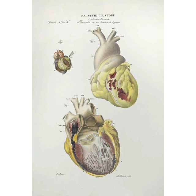 Heart Diseases is a lithograph hand colored by Ottavio Muzzi for the edition of Antoine Chazal,Human Anatomy, Printers...