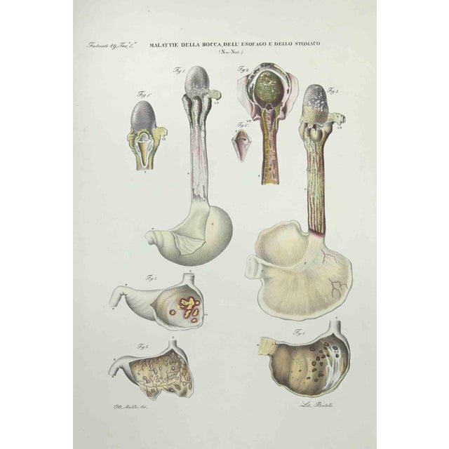 Brain Diseases is a lithograph hand colored by Ottavio Muzzi for the edition of Antoine Chazal,Human Anatomy, Printers...