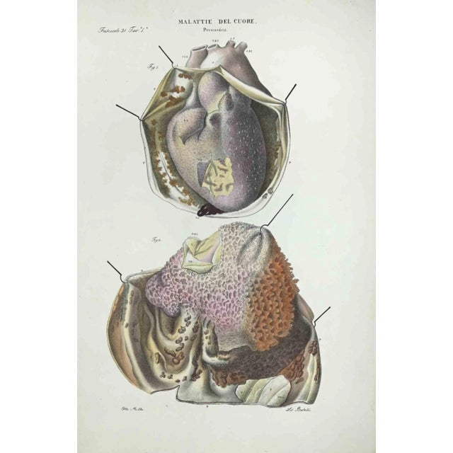 Heart Diseases is a lithograph hand colored by Ottavio Muzzi for the edition of Antoine Chazal,Human Anatomy, Printers...