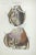 Heart Diseases is a lithograph hand colored by Ottavio Muzzi for the edition of Antoine Chazal,Human Anatomy, Printers...