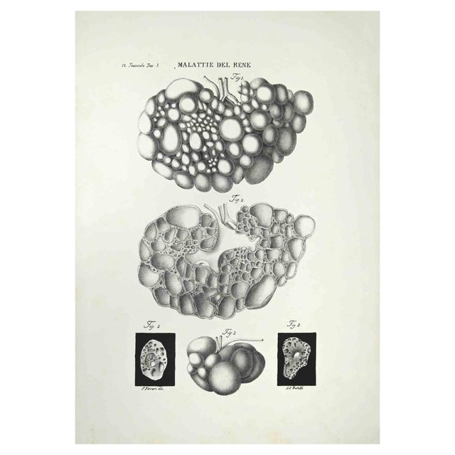 Ottavio Muzzi, Kidney Diseases, Lithograph, 1843 For Sale