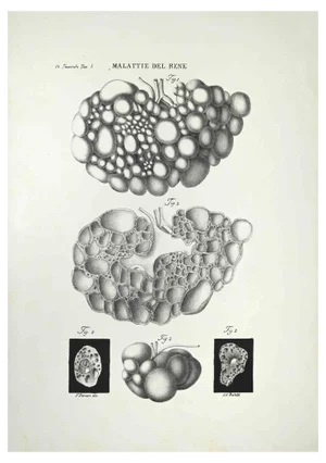 Ottavio Muzzi, Kidney Diseases, Lithograph, 1843