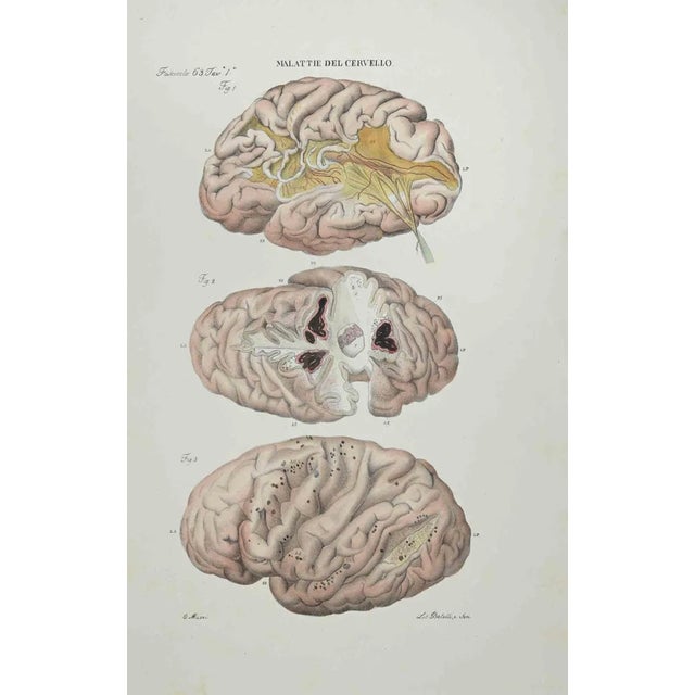Ottavio Muzzi, Diseases of the Brain, Lithograph, 1843 For Sale