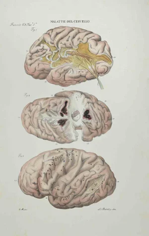 Ottavio Muzzi, Diseases of the Brain, Lithograph, 1843