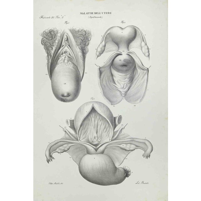 Uterus Diseases is a lithograph hand colored by Ottavio Muzzi for the edition of Antoine Chazal,Human Anatomy, Printers...