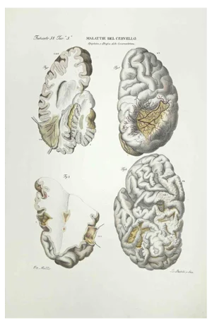 Ottavio Muzzi, Brain Diseases, Lithograph, 1843