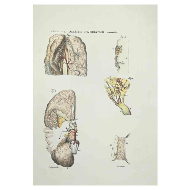Ottavio Muzzi, Brain Diseases, Lithograph, 1843 For Sale