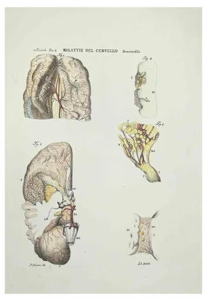 Ottavio Muzzi, Brain Diseases, Lithograph, 1843