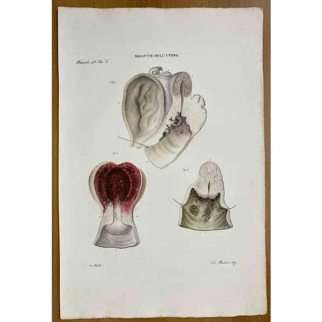 Diseases of Uterus is a lithograph hand colored by Ottavio Muzzi for the edition of Antoine Chazal, Human Anatomy,...