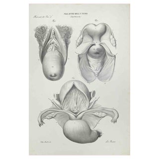 Ottavio Muzzi, Uterus Diseases, Lithograph, 1843 For Sale