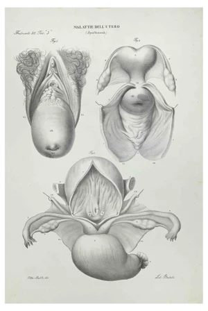 Ottavio Muzzi, Uterus Diseases, Lithograph, 1843