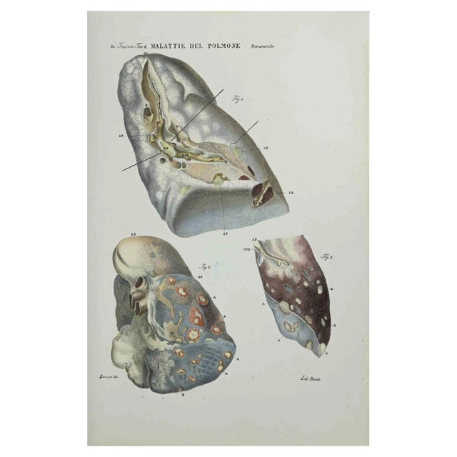 Ottavio Muzzi, Lung Diseases, Lithograph, 1843 For Sale