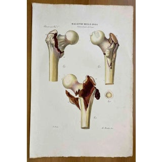 Ottavio Muzzi, Bone Diseases, Lithograph, 1843 For Sale