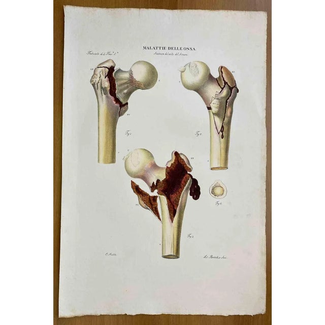Ottavio Muzzi, Bone Diseases, Lithograph, 1843 For Sale