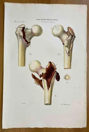 Ottavio Muzzi, Bone Diseases, Lithograph, 1843