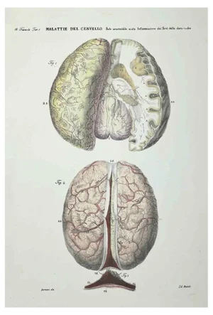 Ottavio Muzzi, Brain Diseases, Lithograph, 1843