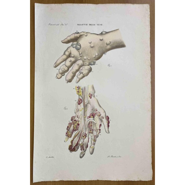 Ottavio Muzzi, Vein Diseases, Lithograph, 1843 For Sale