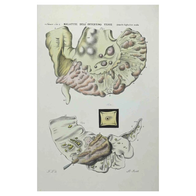 Ottavio Muzzi, Small Intestine Diseases, Lithograph, 1843 For Sale
