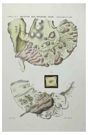 Ottavio Muzzi, Small Intestine Diseases, Lithograph, 1843