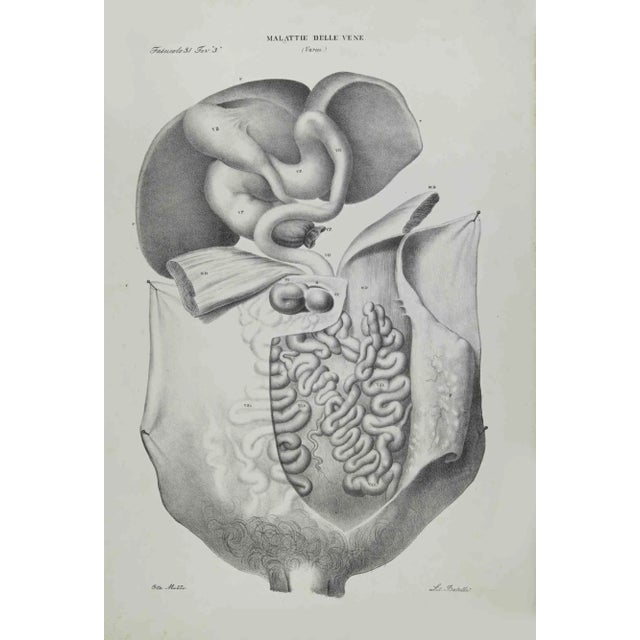 Veins Diseases is a lithograph hand colored by Ottavio Muzzi for the edition of Antoine Chazal,Human Anatomy, Printers...