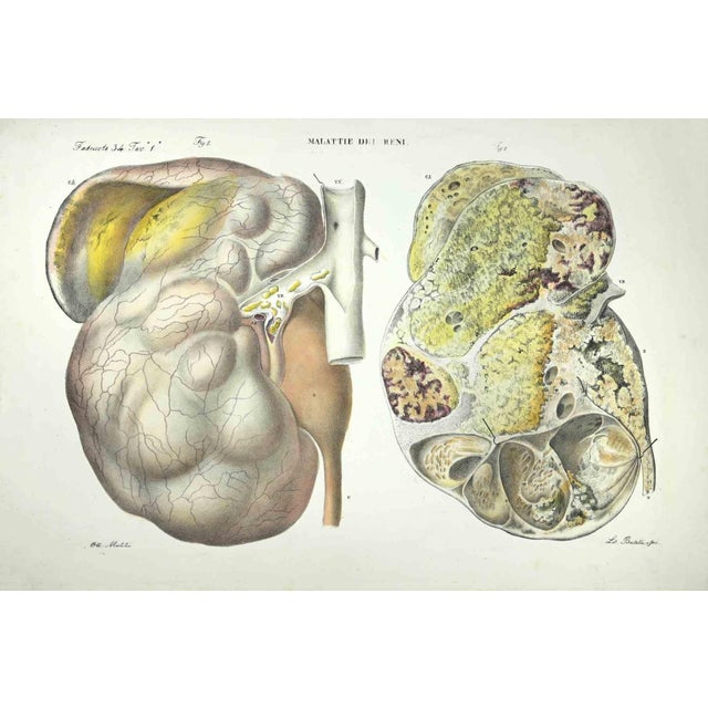 Kidney Diseases is a lithograph hand colored by Ottavio Muzzi for the edition of Antoine Chazal, Human Anatomy, Printers...