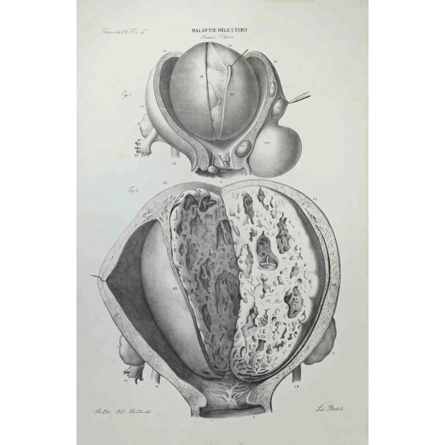 Uterus Diseases is a lithograph hand colored by Ottavio Muzzi for the edition of Antoine Chazal,Human Anatomy, Printers...