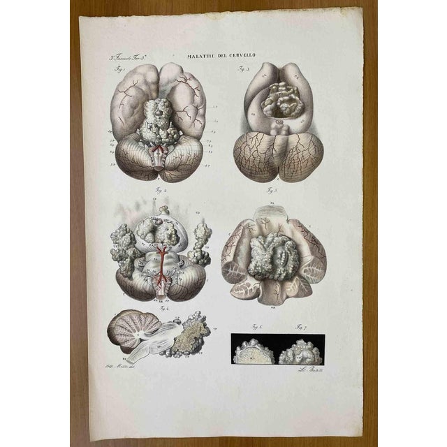Ottavio Muzzi, Brain Diseases, Lithograph, 1843 For Sale
