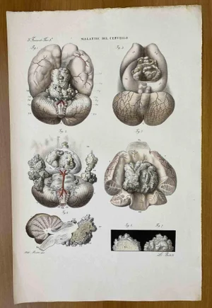 Ottavio Muzzi, Brain Diseases, Lithograph, 1843