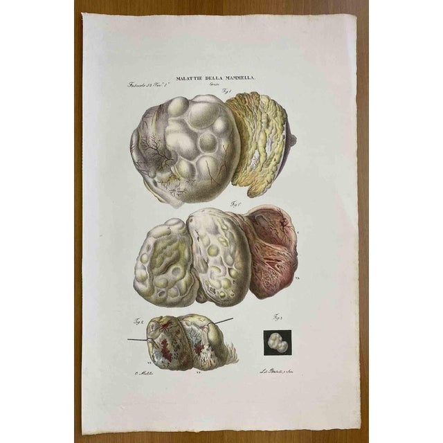 Breast Diseases is a lithograph hand colored by Ottavio Muzzi for the edition of Antoine Chazal, Human Anatomy, Printers...
