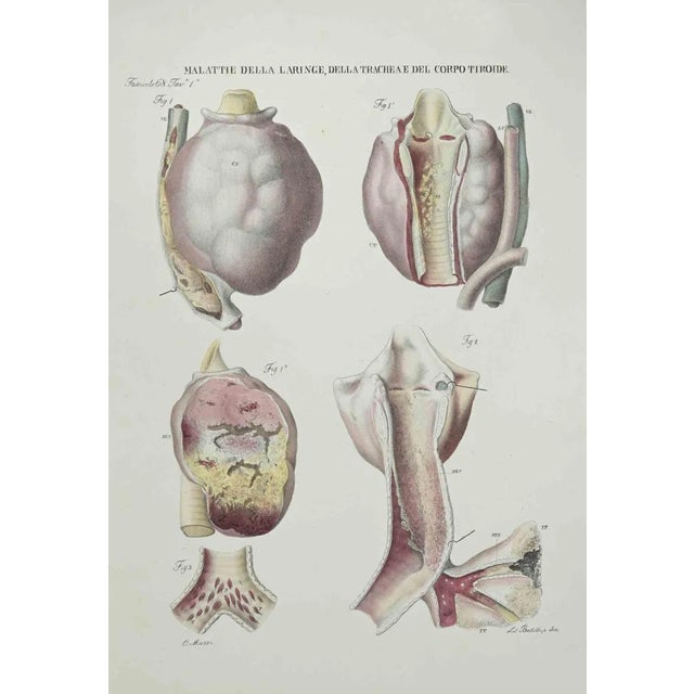 Diseases of the Larynx, Trachea and Thyroid Body is a lithograph hand colored by Ottavio Muzzi for the edition of Antoine...